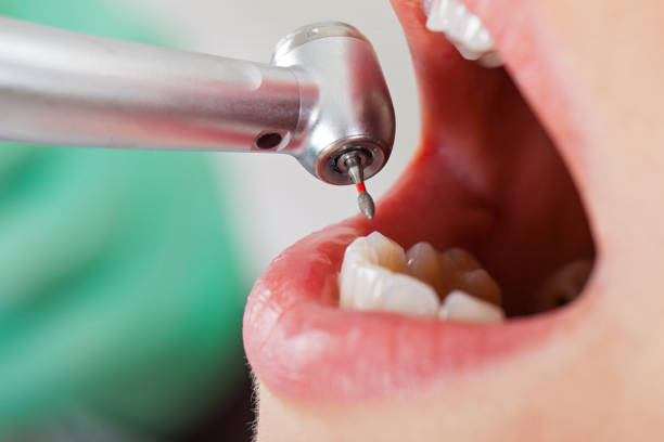 Best Emergency Wisdom Tooth Extraction in Dublin, GA
